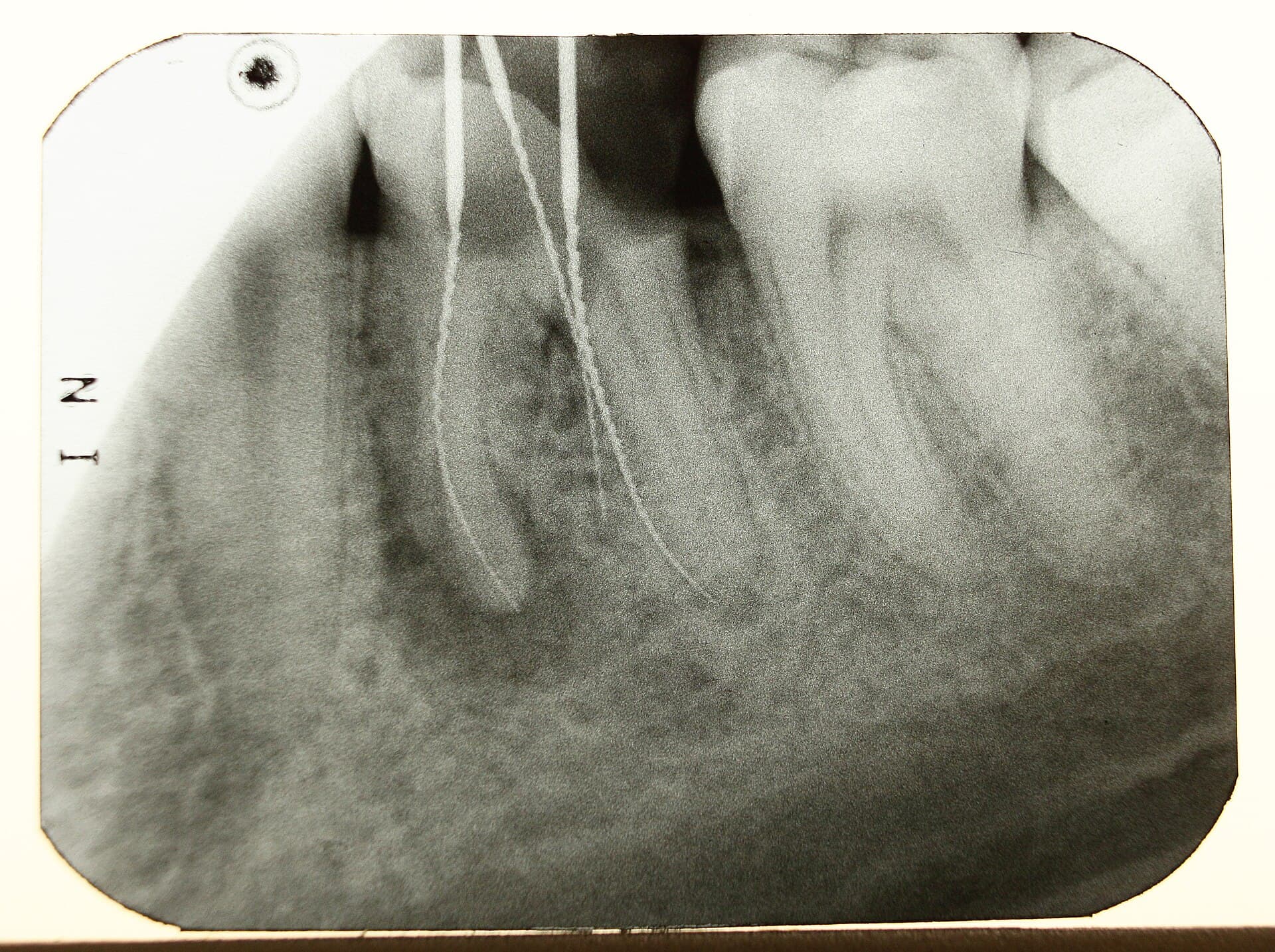 A dental radiograph showing several teeth